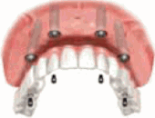 総入れ歯からインプラント