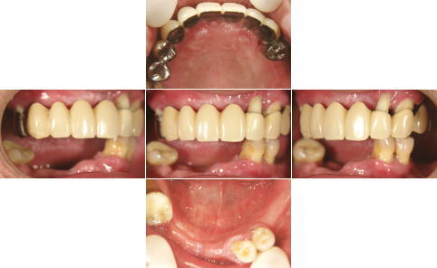 All-on-4前の組画像