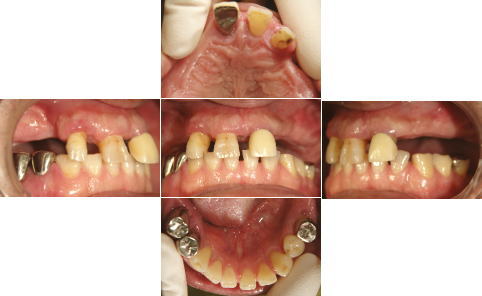 All-on-4前の組画像