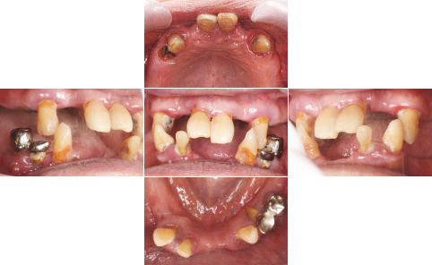 All-on-4 ビフォーアフター写真